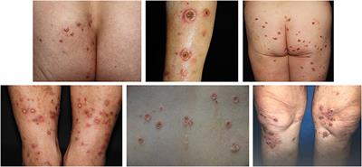 Dermoscopy Features of Acquired Perforating Dermatosis Among 39 Patients